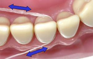 <span class="mw-page-title-main">Dental floss</span> Cord of thin filaments used in interdental cleaning