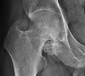 X-ray of synovial chondromatosis.jpg