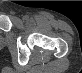 CT of pigmented villonodular synovitis.jpg