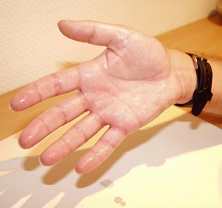 <span class="mw-page-title-main">Palmoplantar hyperhidrosis</span> Excessive sweating localized to the hands and feet