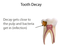 <span class="mw-page-title-main">Pulpotomy</span>