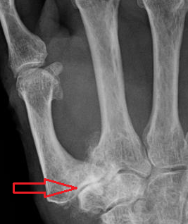 <span class="mw-page-title-main">Trapeziometacarpal osteoarthritis</span> Medical condition