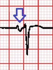 ECG of V1 showing the large negative of the P wave indicating left atrial enlargement E307 (CardioNetworks ECGpedia) (cropped).jpg