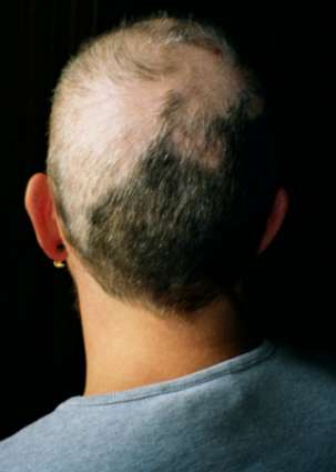 <span class="mw-page-title-main">Trichotillomania</span> Medical condition