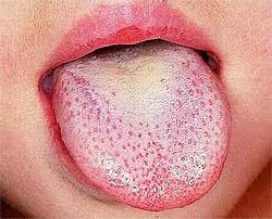 <span class="mw-page-title-main">Scarlet fever</span> Infectious disease caused by Streptococcus pyogenes