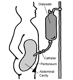 <span class="mw-page-title-main">Peritoneal dialysis</span> Blood purification procedure using the abdominal peritoneum