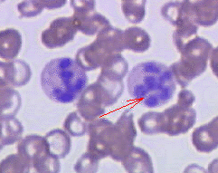 <span class="mw-page-title-main">Megaloblastic anemia</span> Medical condition