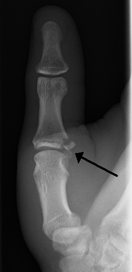 <span class="mw-page-title-main">Ulnar collateral ligament injury of the thumb</span> Medical condition