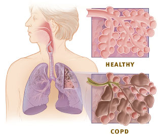 <span class="mw-page-title-main">Chronic obstructive pulmonary disease</span> Lung disease involving long-term poor airflow