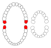 <span class="mw-page-title-main">Wisdom tooth</span> Large tooth at the back of the human mouth