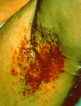 <span class="mw-page-title-main">Streptococcal intertrigo</span> Medical condition