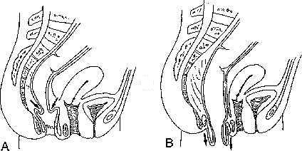 A. Internal rectal intussusception. B. External (complete) rectal prolapse Internalrectalintussusceptionexternalrectalprolapse.JPG