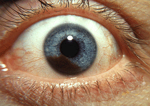 <span class="mw-page-title-main">Uveal melanoma</span> Type of eye cancer