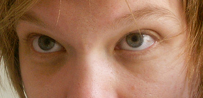 <span class="mw-page-title-main">Periorbital dark circles</span> Medical condition