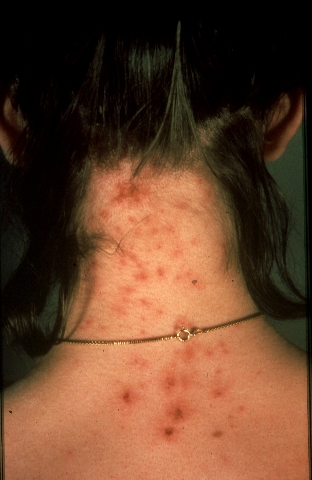 <span class="mw-page-title-main">Head lice infestation</span> Medical condition