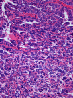 <span class="mw-page-title-main">Choroid plexus carcinoma</span> Medical condition