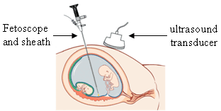 <span class="mw-page-title-main">Fetoscopy</span> Endoscopic procedure during pregnancy