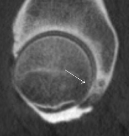 Sagittal CT-arthrography of chondral injury.jpg