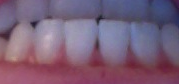 <span class="mw-page-title-main">Angularis nigra</span> Small triangle-shaped gap which often occurs between the teeth, near the gums