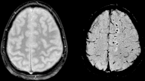 <span class="mw-page-title-main">Diffuse axonal injury</span> Medical condition