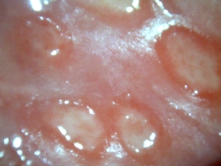 <span class="mw-page-title-main">Genital ulcer</span> Ulcer located on the genital area