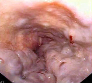 <span class="mw-page-title-main">Esophageal varices</span> Medical condition