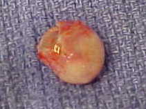 <span class="mw-page-title-main">Trichilemmal cyst</span> Common cyst that forms from a hair follicle