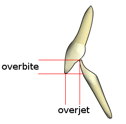 <span class="mw-page-title-main">Overjet</span> Medical condition