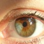 Heterocromia setorial