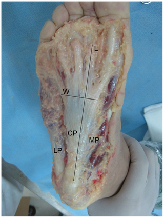 <span class="mw-page-title-main">Plantar fascial rupture</span> Medical condition