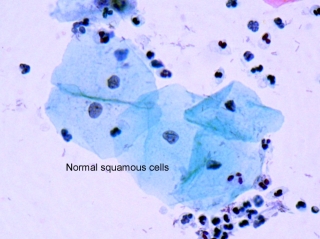 <span class="mw-page-title-main">Dysplasia</span> Abnormal development, at macroscopic or microscopical level