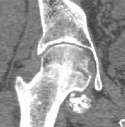 CT of synovial chondromatosis.jpg