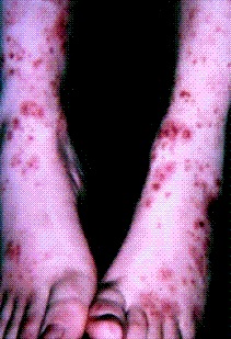 <span class="mw-page-title-main">Lupus vasculitis</span> Medical condition