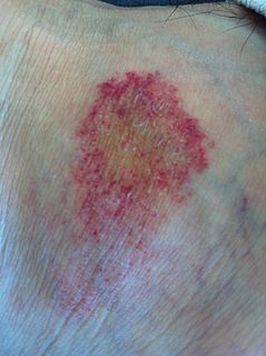 Pigmented purpuric dermatosis human disease