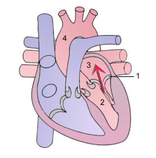 Mitral regurgitation Form of valvular heart disease