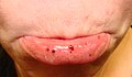 Oral petechiae/purpura — lower lip