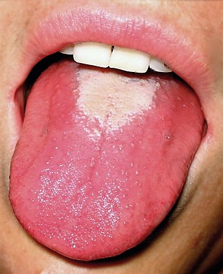 <span class="mw-page-title-main">Glossitis</span> Medical condition