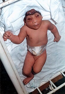 An infant with anencephaly and acrania Anencefalia.jpg