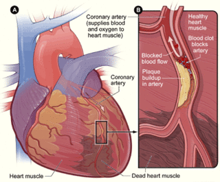 <span class="mw-page-title-main">Management of acute coronary syndrome</span>