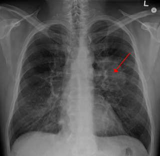 <span class="mw-page-title-main">Lung tumor</span> Medical condition