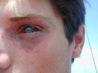 <span class="mw-page-title-main">Barotrauma</span> Injury caused by pressure