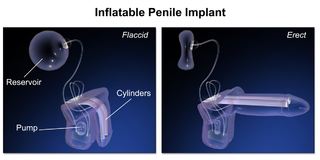 <span class="mw-page-title-main">Penile implant</span> Medical device