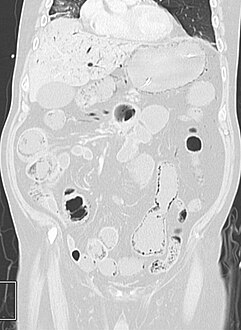 Pneumatosis intestinalis in the coronal computed tomography in lung window. It can be seen next to gas entrapment in the bowel wall and gas in the stomach wall and in numerous vessels, including the portal vein into the liver.