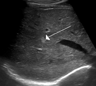 <span class="mw-page-title-main">Cavernous liver hemangioma</span> Medical condition