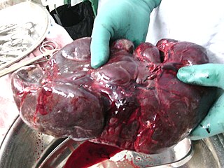 <span class="mw-page-title-main">Splenectomy</span> Surgical removal of the spleen