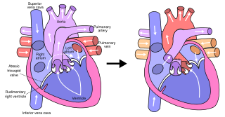 <span class="mw-page-title-main">Fontan procedure</span> Surgical procedure used in children with univentricular hearts