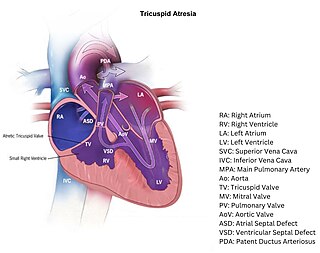 <span class="mw-page-title-main">Hypoplastic right heart syndrome</span> Type of congenital heart disease