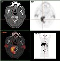 Osteolytische Knochenmetastase im zweiten Halswirbelknochen (Axis) eines metastasierten Prostatakarzinoms