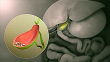 3D still showing gallstones Gallbladder stones.jpg