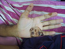 Osler Nodules Hand.jpg